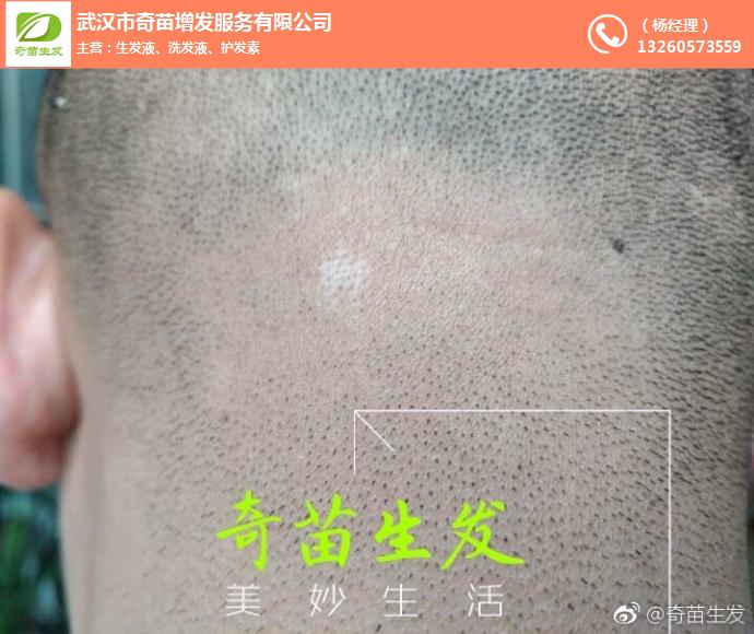 斑禿,奇苗增發(圖),斑禿的zl方法